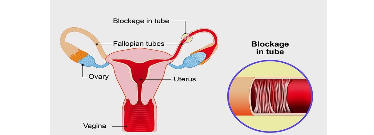 गर्भाशय ट्यूब | फैलोपियन ट्यूब की रुकावट